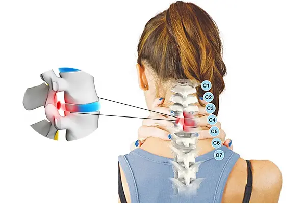 Lồi đĩa đệm C3 C4 ở dân văn phòng thường là do ít vận động, ngồi nhiều.webp